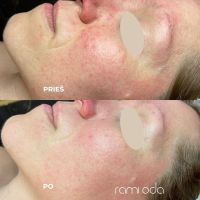 Veido valymas Kaune. Rezultatai po rūgštinio veido valymo.