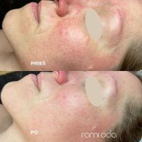 Veido valymas Kaune. Rezultatai po rūgštinio veido valymo.