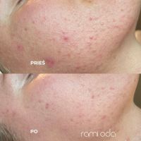 Rezultatai atlikus rūgštinio veido valymas procedūrą.